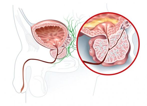 Sintomas sa prostatitis