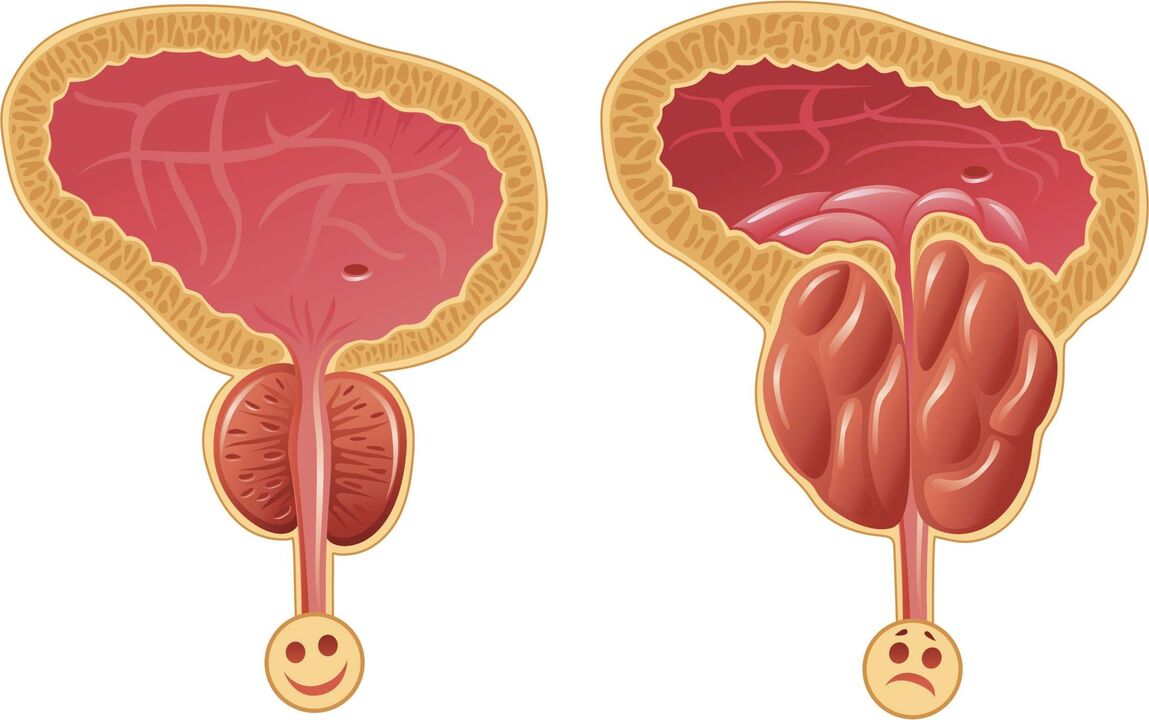 hinungdan sa pag-uswag sa prostatitis