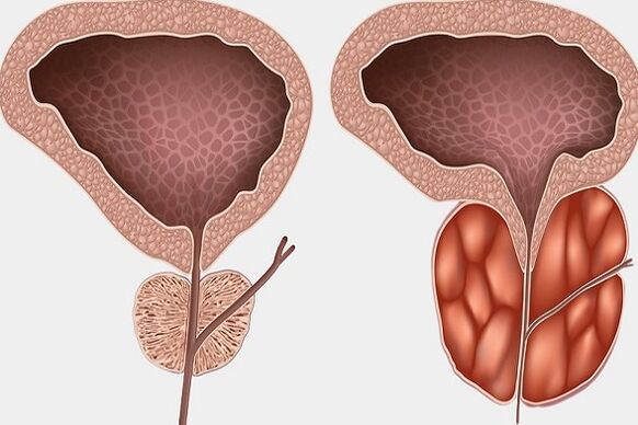 Panghubag sa prostate