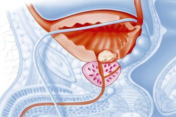 Proseso sa panghubag sa prostate