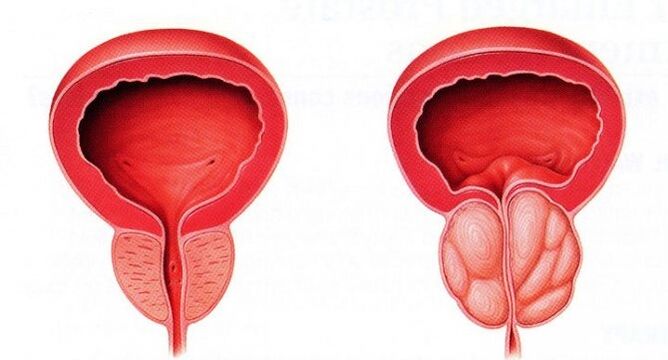 himsog ug inflamed prostate nga adunay laygay nga prostatitis