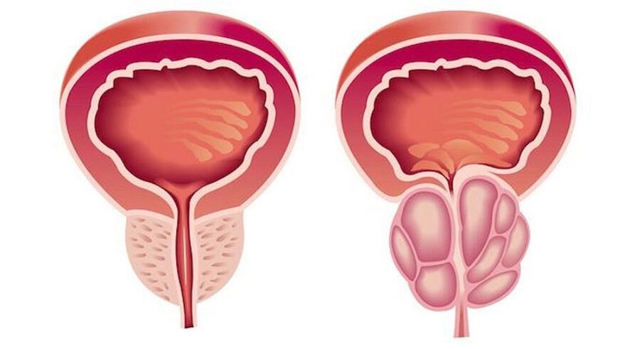 Himsog ug inflamed prostate nga adunay prostatitis
