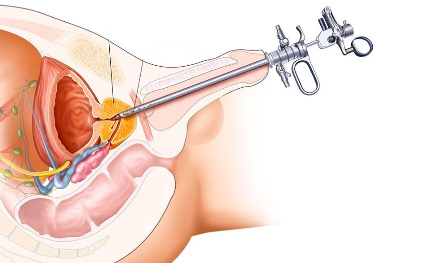 Pagtambal sa Surgical sa Prostatitis