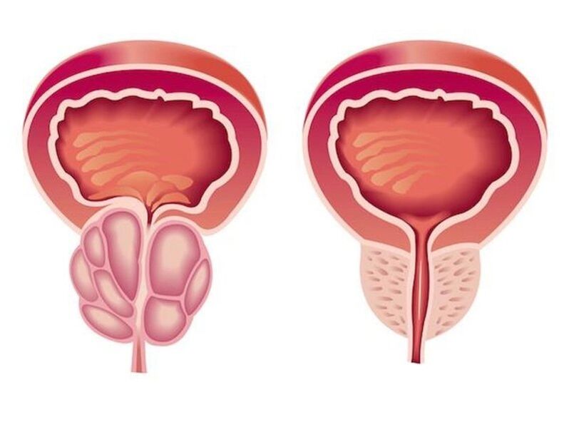 Unsa ang hitsura sa prostatitis